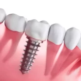 Unveiling the Role of Virtual Reality in Dental Implant Planning