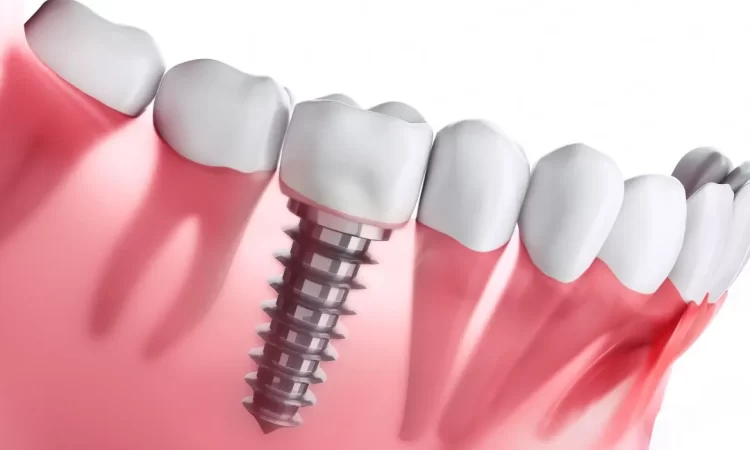 Unveiling the Role of Virtual Reality in Dental Implant Planning